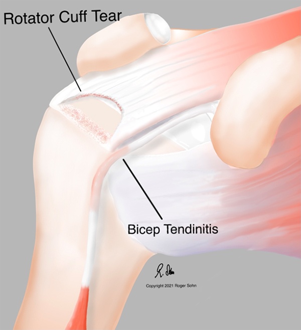Rotator Cuff Repair & Biceps Tenodesis, Medical Case Study